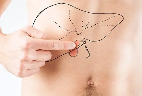 What Is ACL Reconstruction?