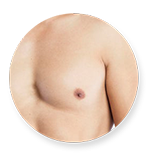 gynecomastia surgery in chennai