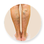 varicose veins surgery in chennai