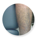 varicose veins surgery in chennai