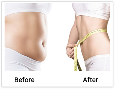 liposuction surgery in chennai