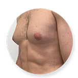 gynecomastia surgery in chennai