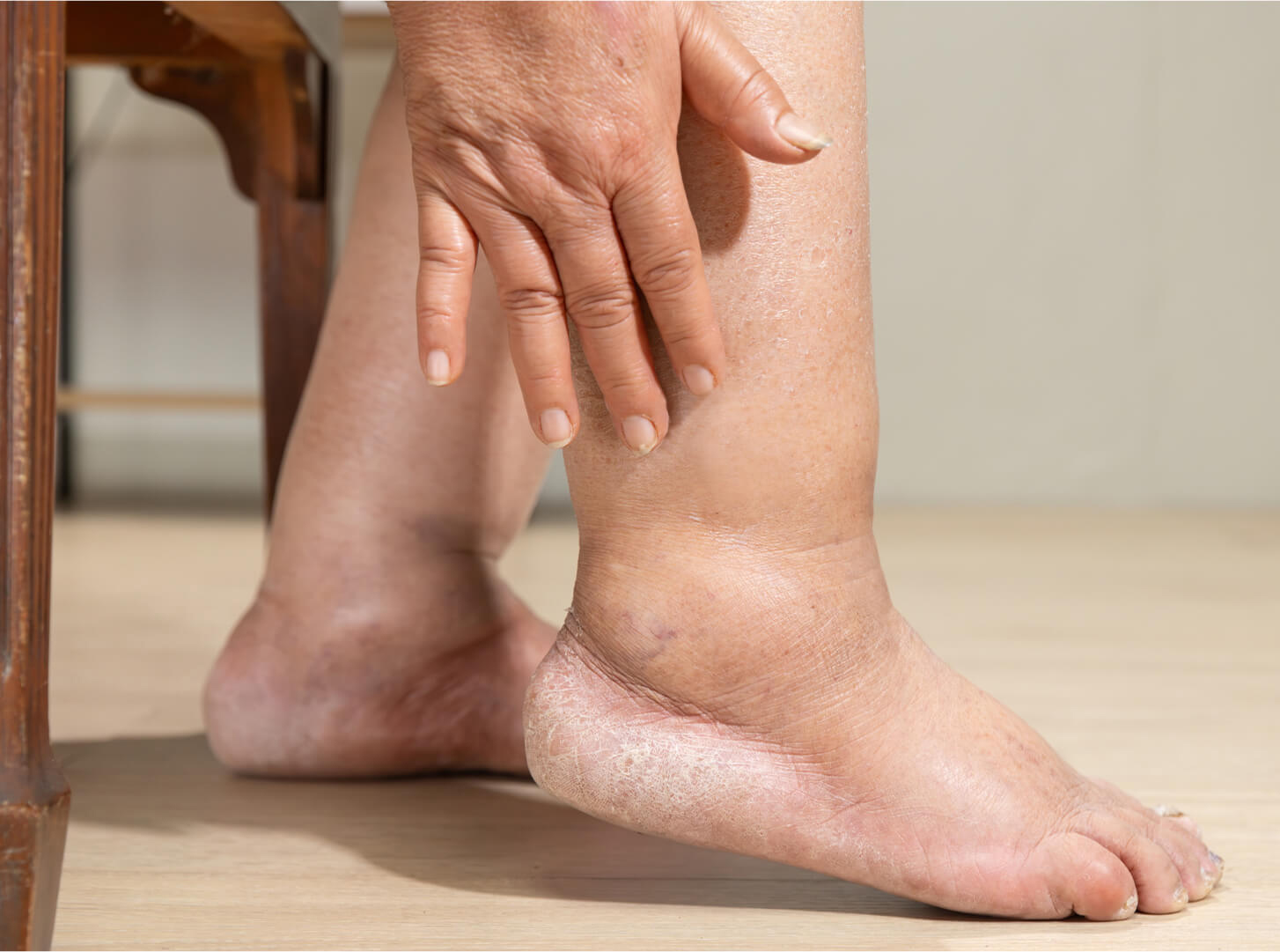 Peripheral Artery Disease Treatment Chennai