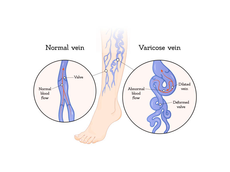 Best Hospital for Varicose Veins Treatment in Tamil Nadu